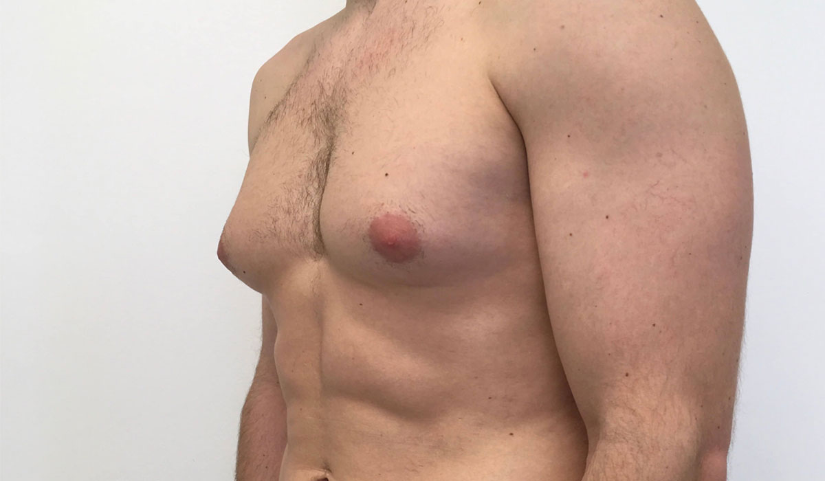 Гинекомастия