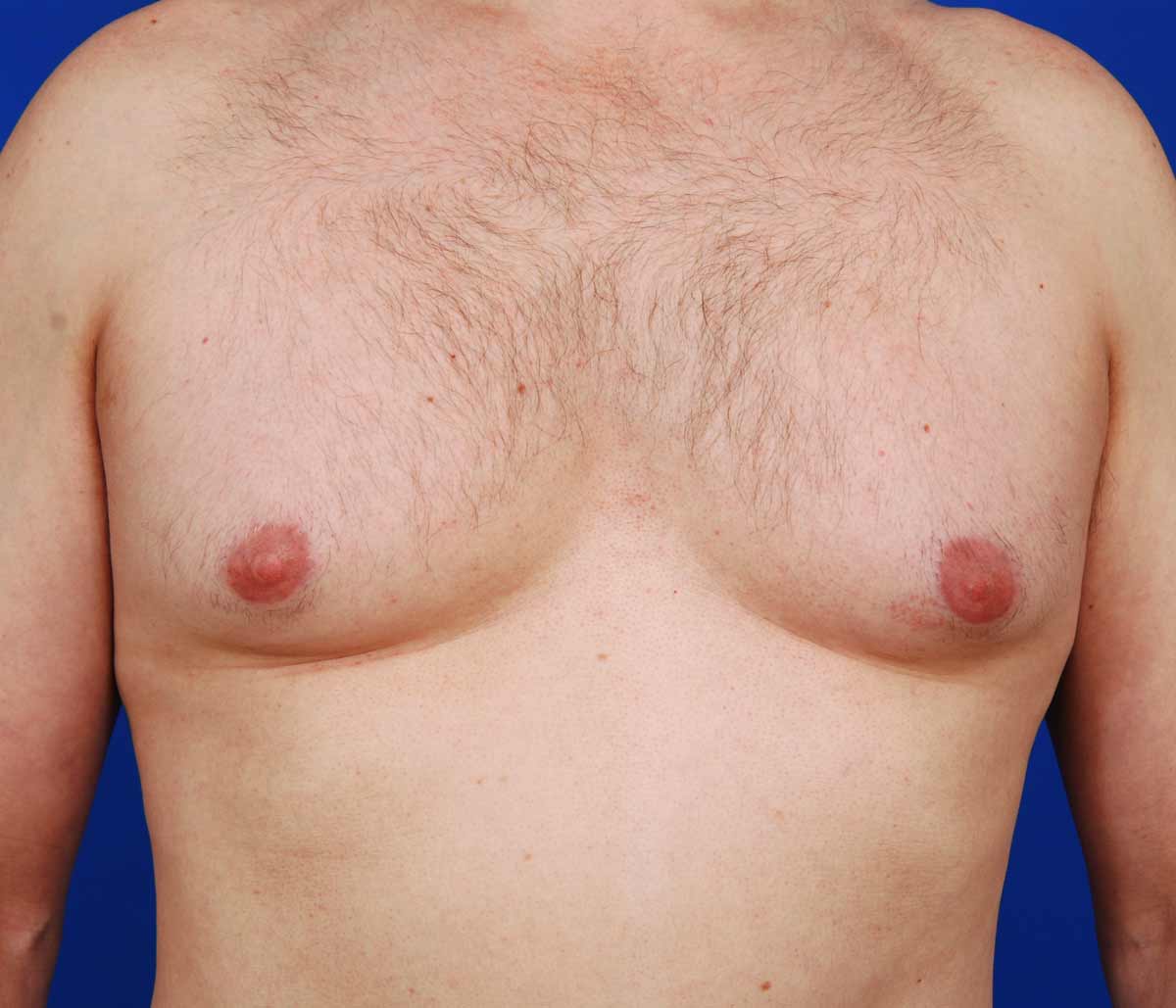 Диагностика гинекомастии