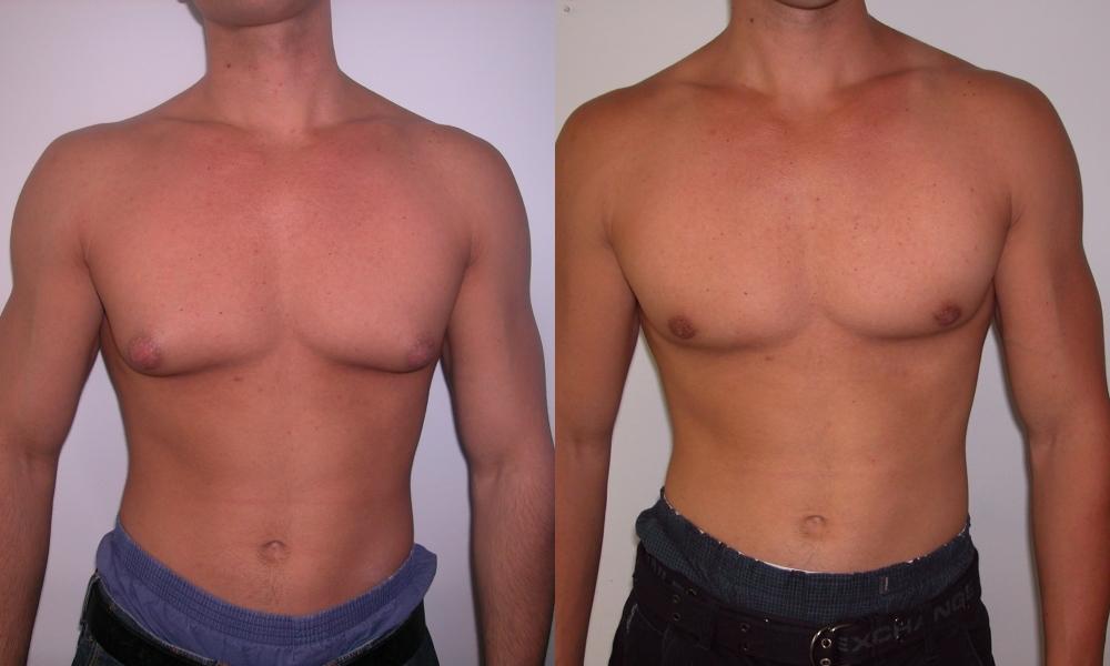 Лечение гинекомастии