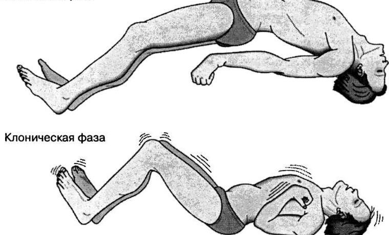 Эпилепсия: симптомы, причины и лечение