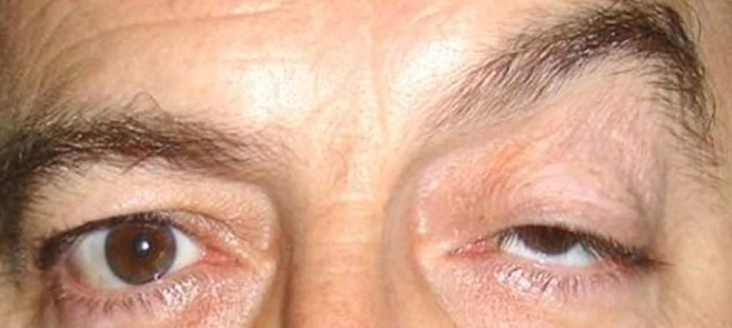 Блефарокалазия или опущенные веки: причины