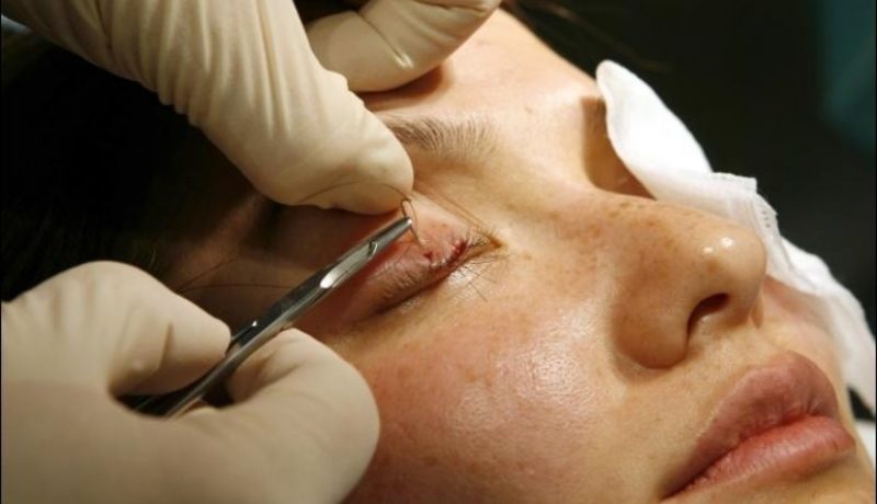 Лечение бефарохалазии