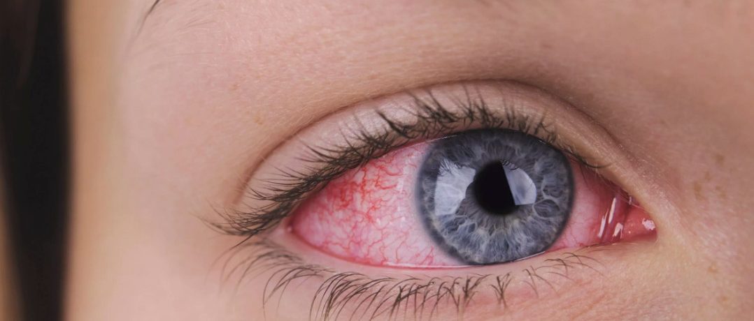 Почему у меня красный глаз?