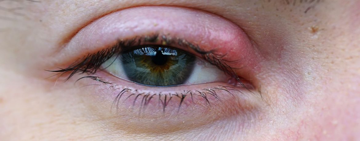 Почему мое веко опухло