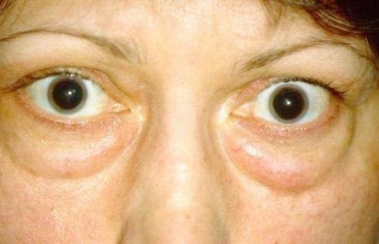 Тиреоидная офтальмопатия – причины и симптомы