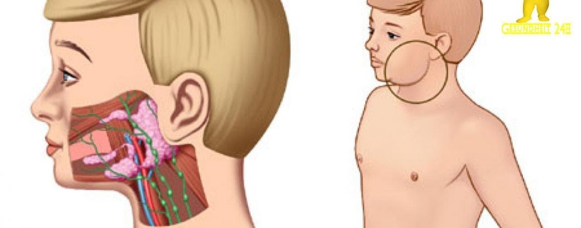 Свинка: симптомы и причины