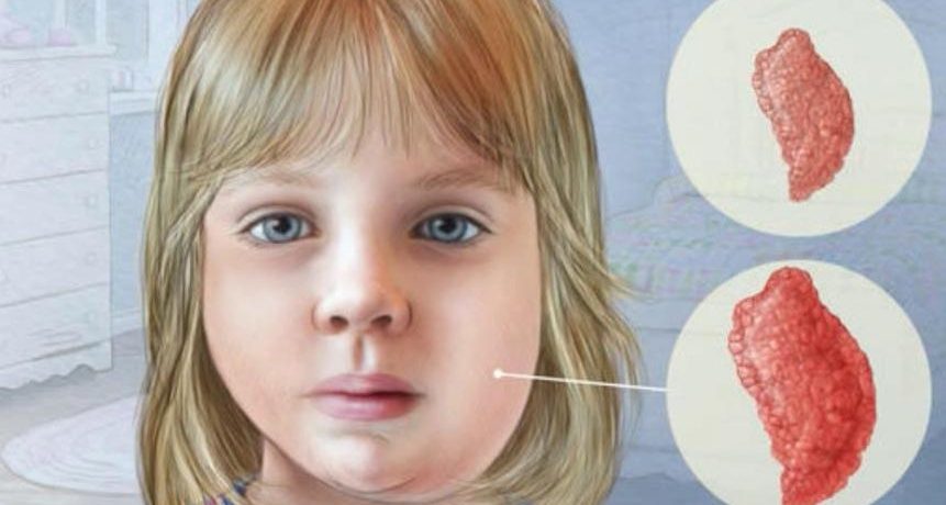 Лечение свинки