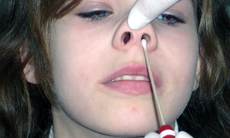 Что такое лечение от носовых полипов?