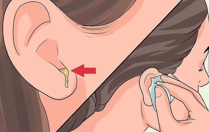 Ринит с головокружением и слизью в ушах