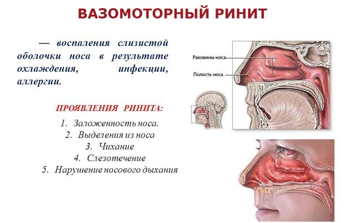 Ринит: типы, симптомы и лечение