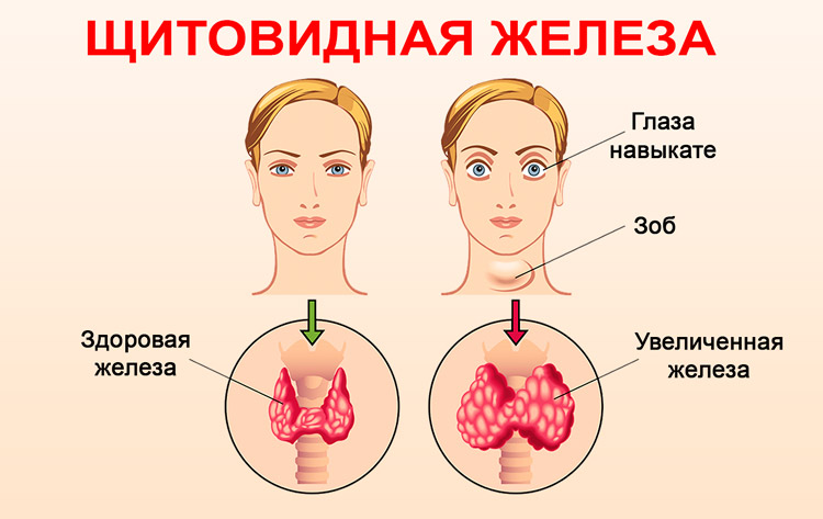Воспаление щитовидной железы: Симптомы