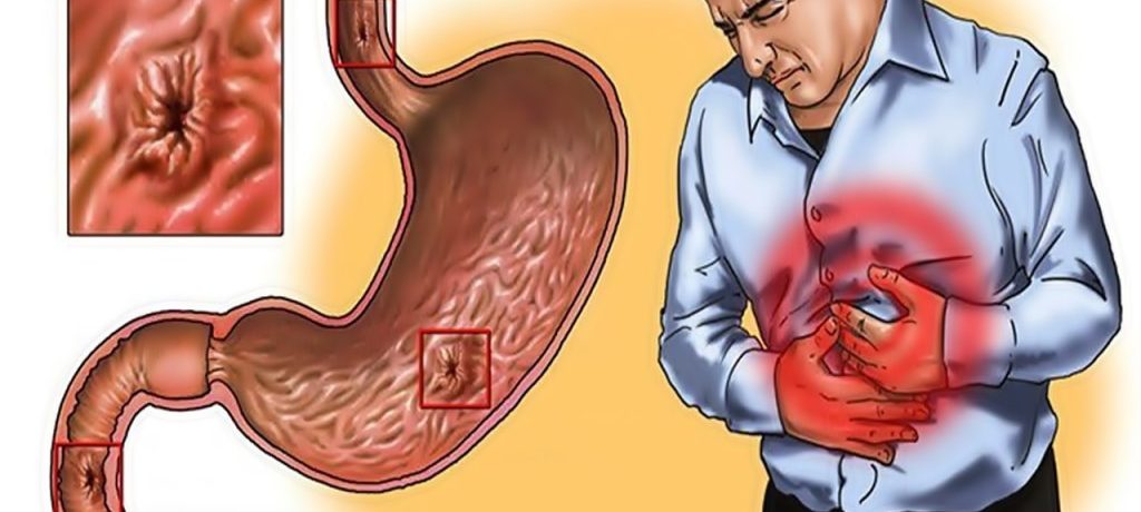 Что мне есть, если у меня язва желудка?