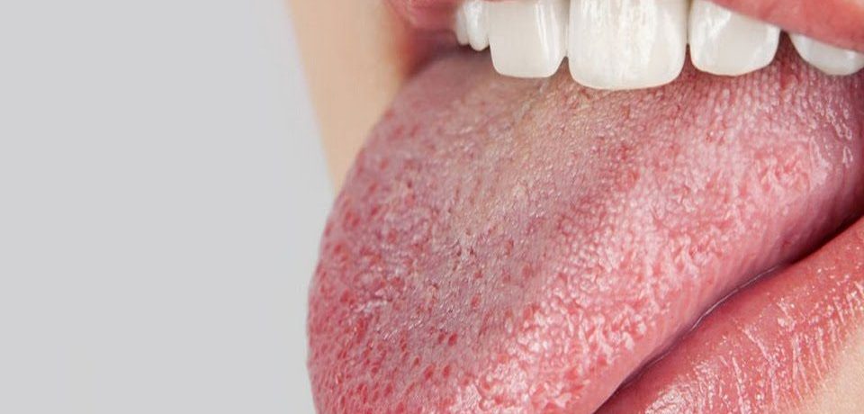 Жжение языка: причины и лечение