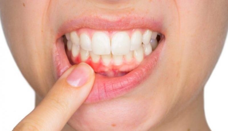 Домашние средства от воспаления десен