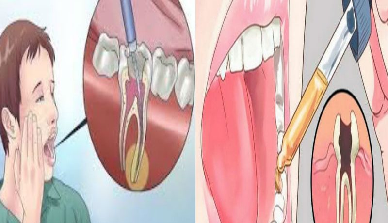 Как снять боль от раскола зуба