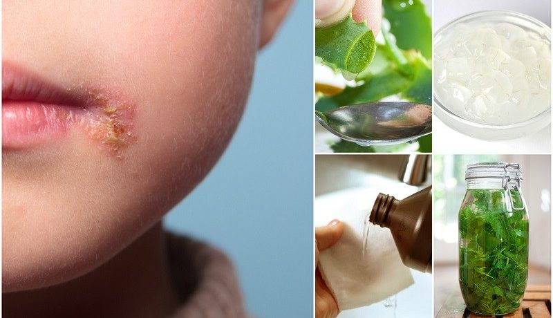 Алоэ вера для лечения герпеса