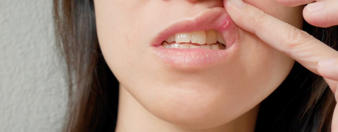 Причины появления ротовых пролежней