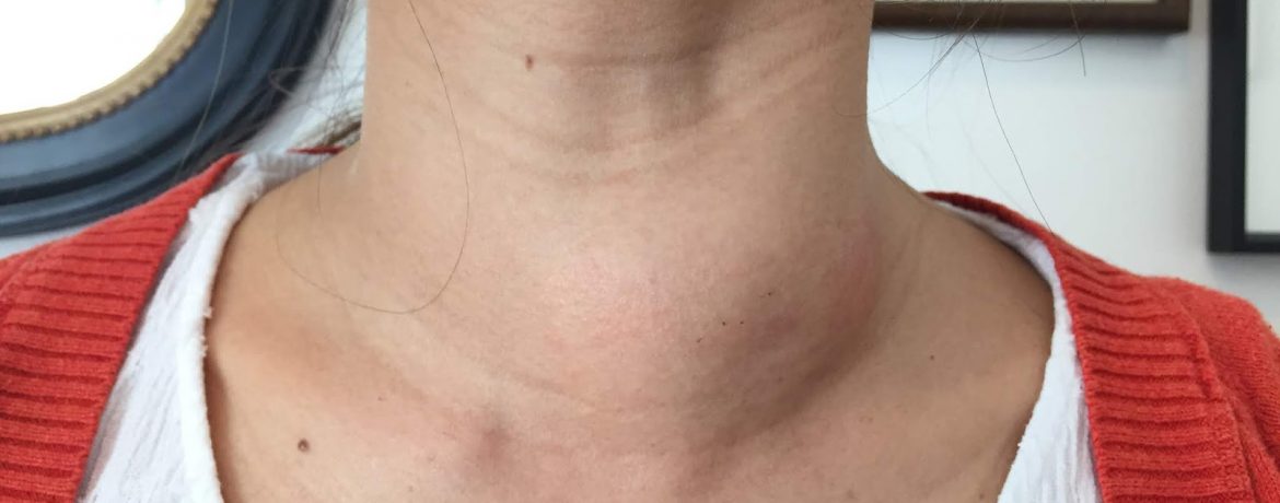 Что если моя щитовидка опухла?