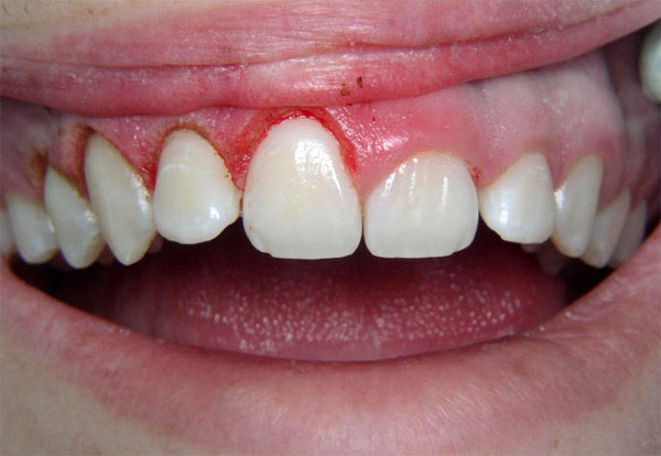 Вытянутые дёсны