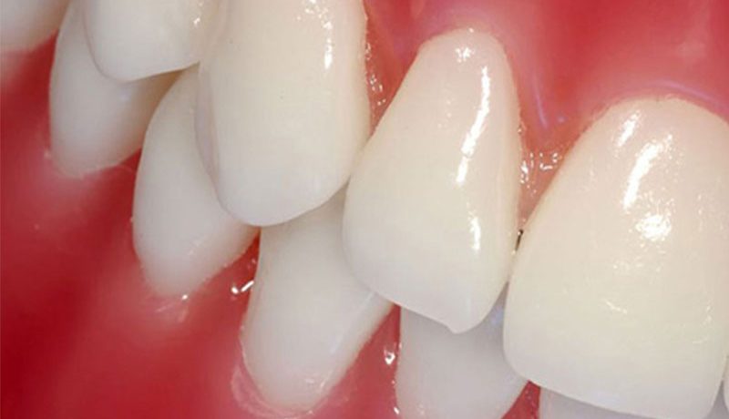 Риск втягивания десны